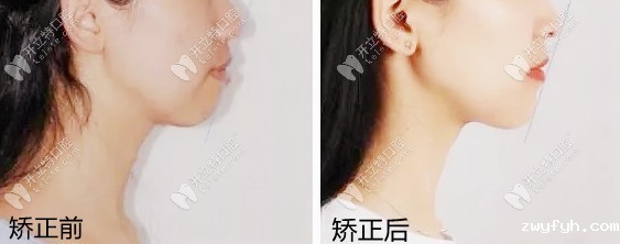 露龈笑戴陶瓷半隐形矫正有效果吗？亲身整牙经历来解答~