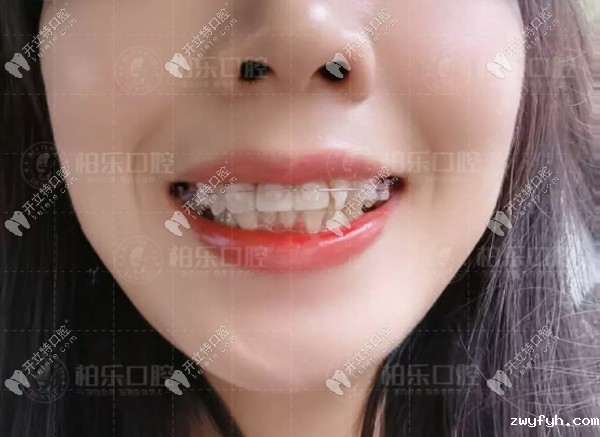 戴陶瓷隐形牙套三个月