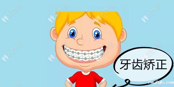 牙齿拥挤+深覆合矫正案例:在成都新桥做的是隐适美正畸