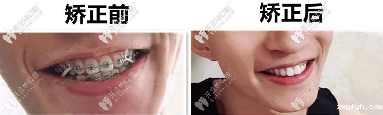 遗传性兔牙：00后男生做美国3M金属自锁托槽矫正前后变化图