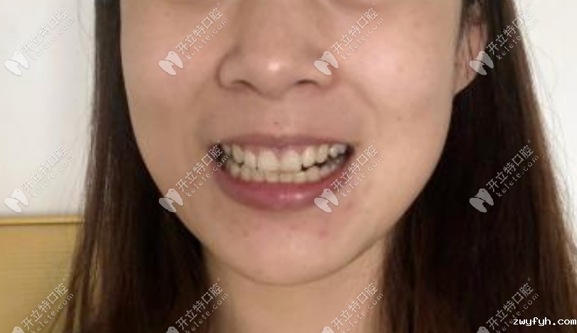 咬合不正导致嘴歪吓得我麻溜去做了奥美科金属托槽矫正
